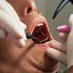 Enjoy The Benefits Of Same-Day Teeth